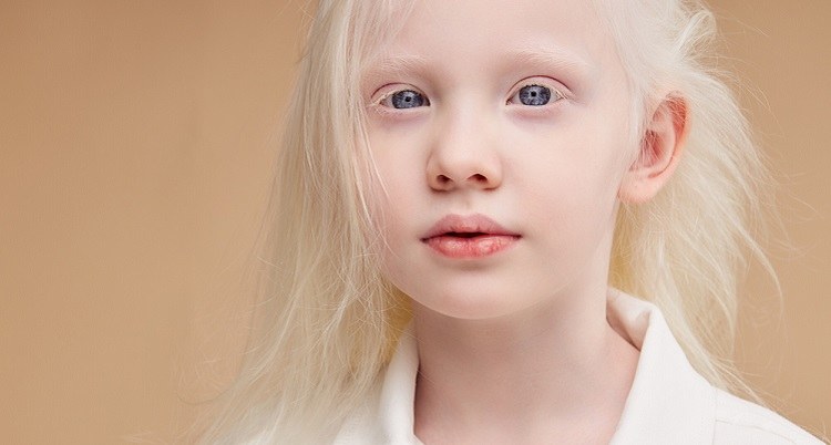 Albino Nedir, Albino insanın özellikleri